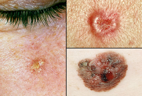Skin cancer growths www.mytributejournal.com
